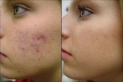 Acne Facial Treatment with Blue Light, Oxygen and Microdermabrasion