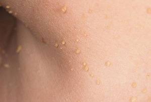 how-to-remove-skin-tags skin-tags-neck