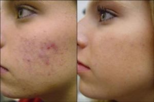 Best acne and acne scar treatment