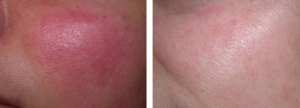 redness couperose rosacea removal face