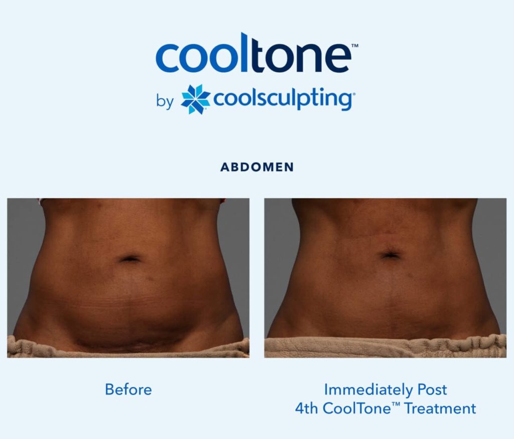 Cooltone™ by CoolSculpting® Advanced Skin Therapy of Smokey Point