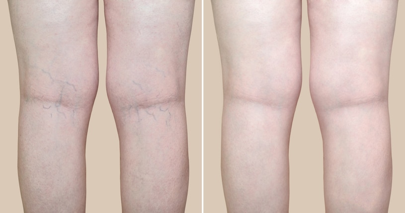 Sclerotherapy Leg Vein Treatment Before and after photo