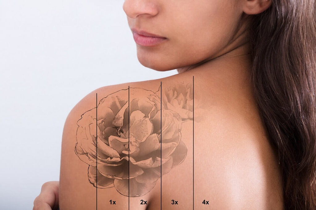 How Long After Laser Tattoo Removal will Tattoo Fade
