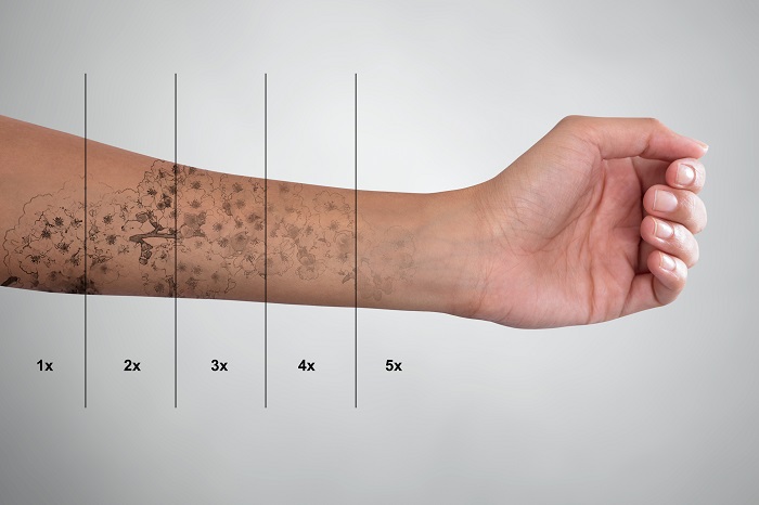 Laser Tattoo Removal Seattle 