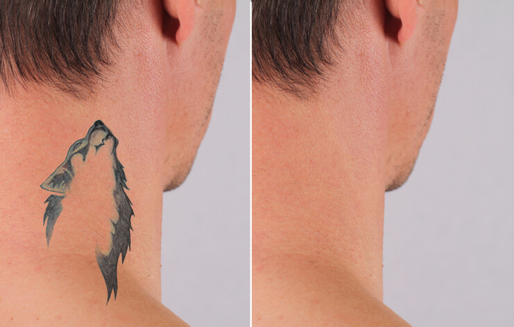 Laser Tattoo Removal Aftercare | Process, Instructions