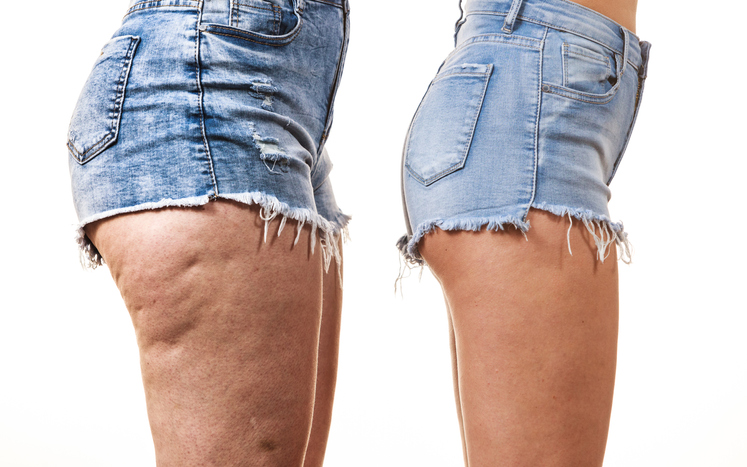 QWO Cellulite Treatment | How Long Does It Last, Cost, Results