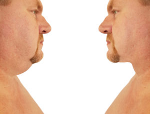 Man double chin treatment before and after